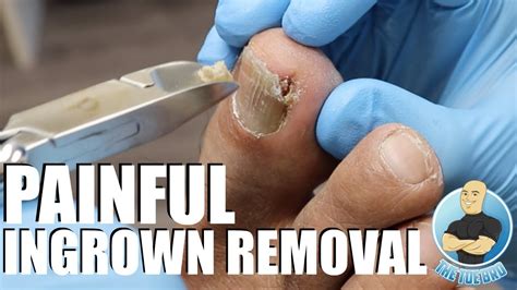 reddit ingrown toenail|ingrown toenail treatment reddit.